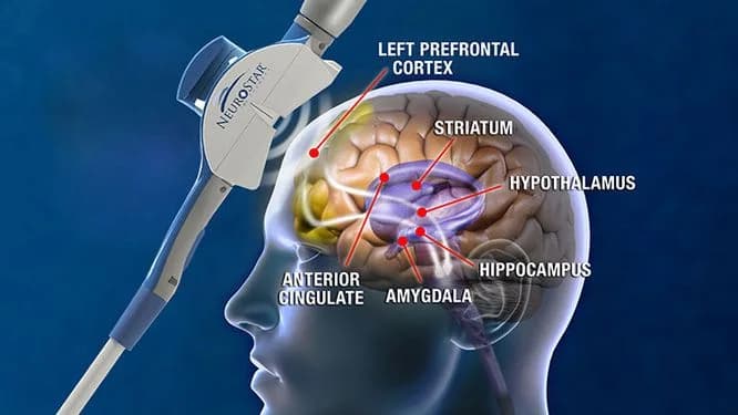 Illustration of a TMS coil positioned over the left side of a translucent head, with the left prefrontal cortex, anterior cingulate, striatum, hypothalamus, hippocampus, and amygdala labeled inside the brain